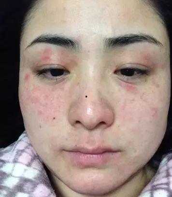 吃毛瓜容易过敏吗,食用需谨慎